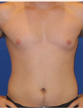 Before Image: Male Breast Reduction - front