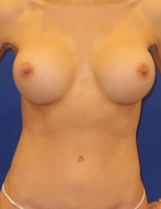 After Image: Mommy Makeover - front