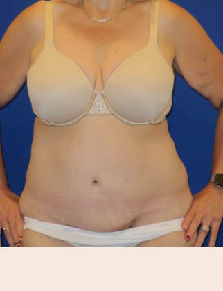After Image: Post Bariatric Body Contouring - front