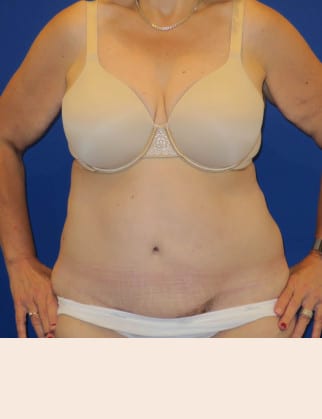 After Image: Abdominoplasty - front