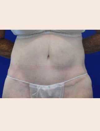 After Image: Post Bariatric Body Contouring - front