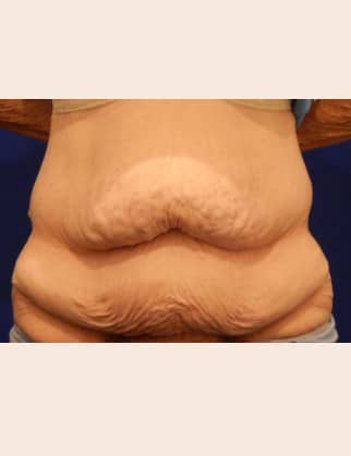 Before Image: Post Bariatric Body Contouring - front