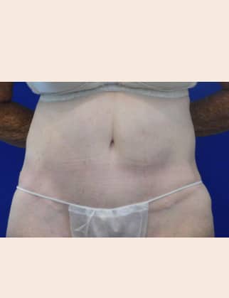After Image: Abdominoplasty - front