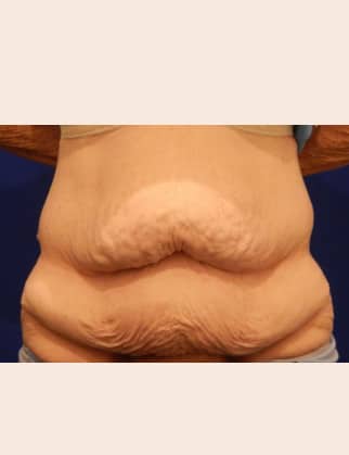 Before Image: Abdominoplasty - front