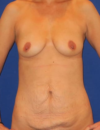 Before Image: Mommy Makeover - front