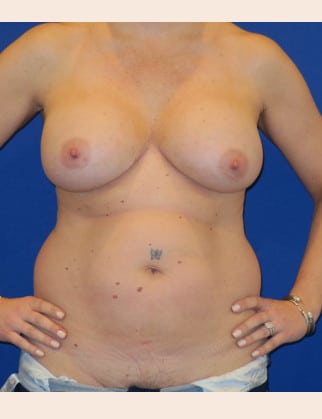 Before Image: Mommy Makeover - front