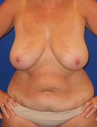 Before Image: Mommy Makeover - front