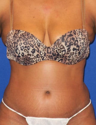After Image: Abdominoplasty - front