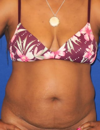 Before Image: Abdominoplasty - front