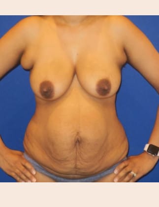 Before Image: Mommy Makeover - front