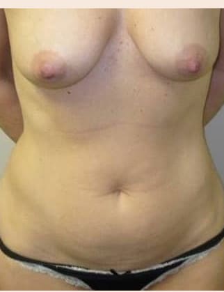Before Image: Mini Tummy Tuck - front