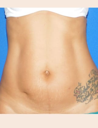 Before Image: Mini Tummy Tuck - front