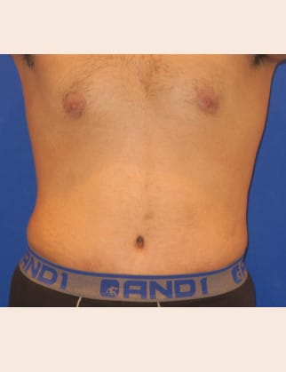 After Image: Male Abdominoplasty - front