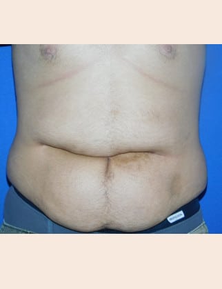 Before Image: Male Abdominoplasty - front
