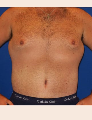 After Image: Male Abdominoplasty - front