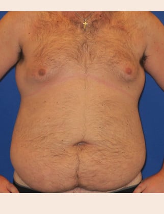Before Image: Male Abdominoplasty - front