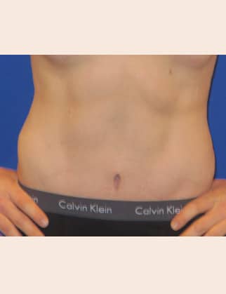 After Image: Male Abdominoplasty - front