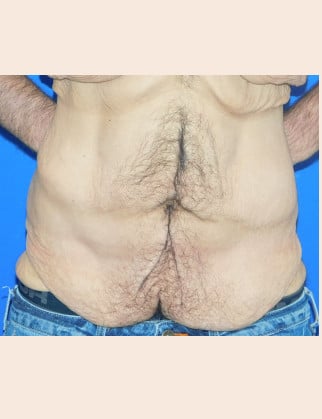 Before Image: Male Abdominoplasty - front