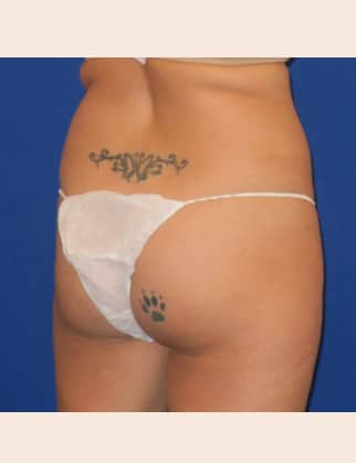 Before Image: Brazilian Buttock Lift - front