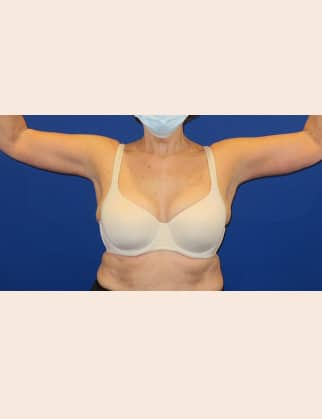After Image: Brachioplasty - front