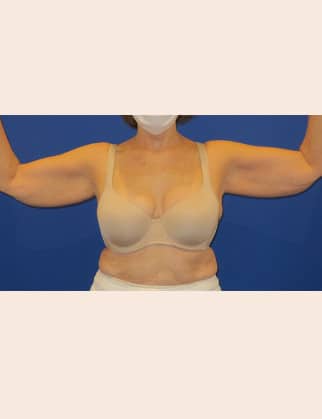 Before Image: Brachioplasty - front